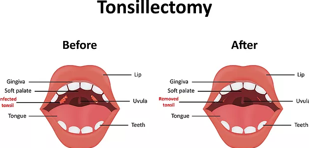 Laser Tonsillectomy