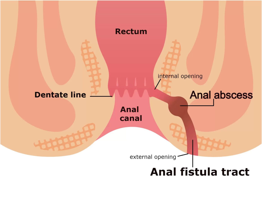 Anal Fistula Laser Treatment
